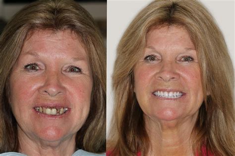 Affordable Dentures Reviews 